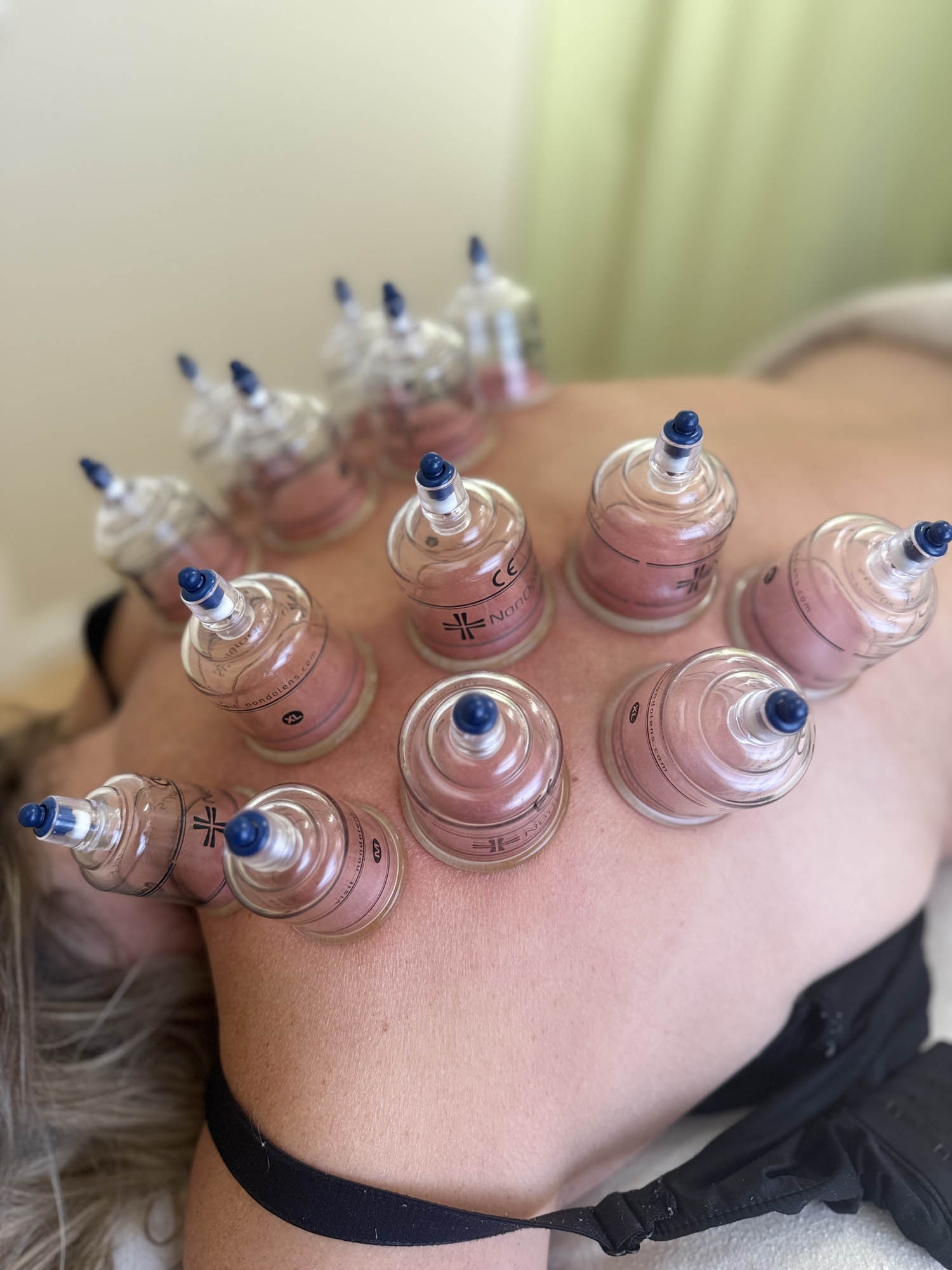 Cupping som en del af kropsterapi i Odense